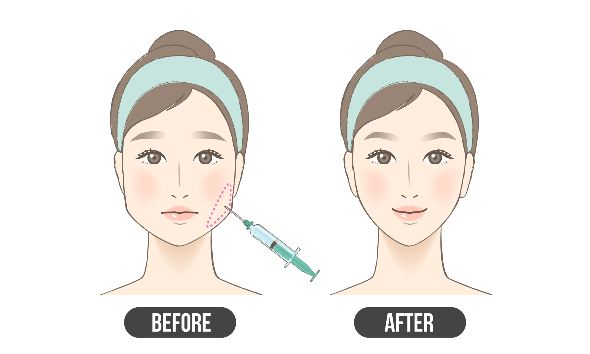 咬筋ボトックスの効果は何ですか?